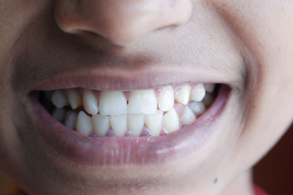 How Breathing Through Your Mouth Affects Your Teeth